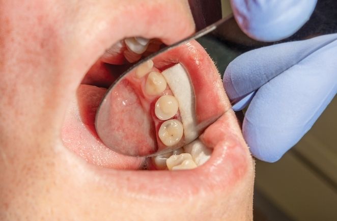 damaged-wisdom-tooth-extraction-hamilton