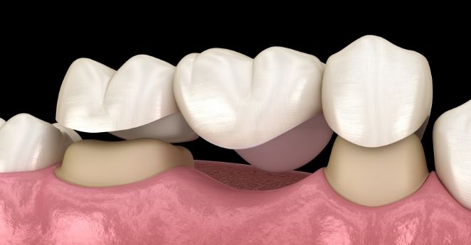 dental-bridge-hamilton-family-dental