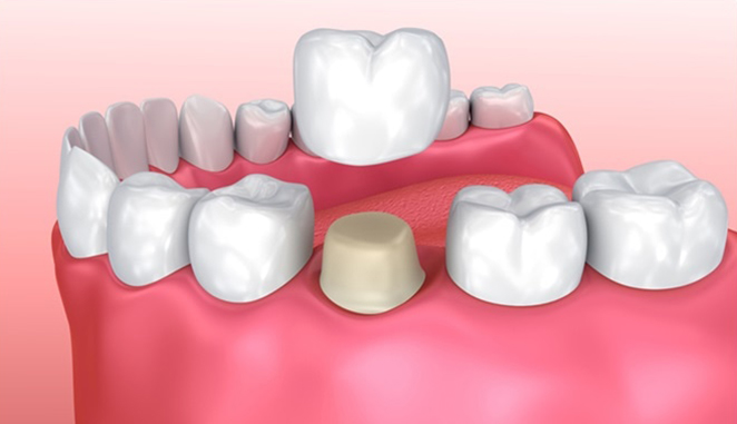 tooth-crown-hamilton