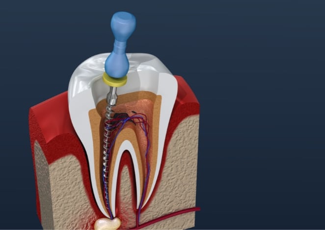 root-canal-treatment-hamilton-family-dental
